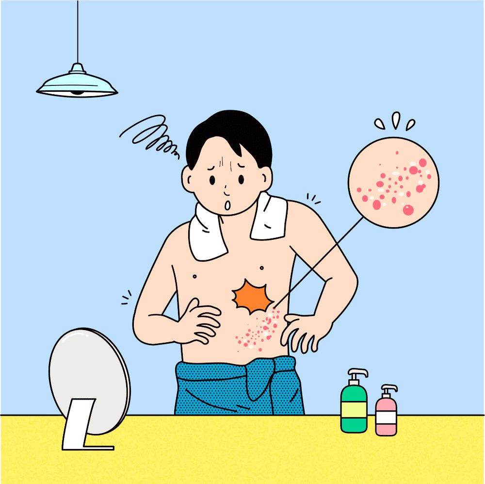 대상포진-일러스트